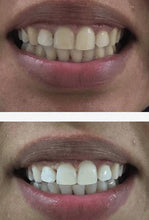 Load image into Gallery viewer, Special Offer - SNOW Teeth Whitening™ System