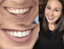 Load image into Gallery viewer, SNOW TEETH WHITENING™ SYSTÈME À DOMICILE [KIT TOUT-EN-UN]
