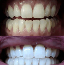 Load image into Gallery viewer, Snow® Teeth Whitening At-Home System [For SweatCoin]
