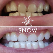 Load image into Gallery viewer, SISTEMA DE CLAREAMENTO DENTAL CASEIRO SNOW™ [KIT TUDO-EM-UM]
