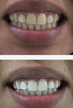 Load image into Gallery viewer, SISTEMA DE CLAREAMENTO DENTAL CASEIRO SNOW™ [KIT TUDO-EM-UM]
