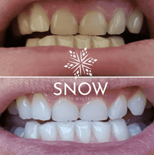 Load image into Gallery viewer, Snow® Teeth Whitening At-Home System [FabFitFun Exclusive]
