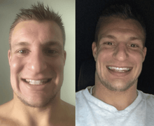 Load image into Gallery viewer, SISTEMA EM CASA SNOW TEETH WHITENING™ [‘KIT’ COMPLETO]
