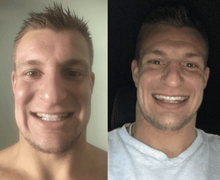 Load image into Gallery viewer, SNOW TEETH WHITENING™ SYSTÈME À DOMICILE [KIT TOUT-EN-UN]
