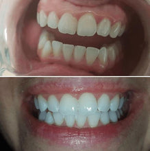 Load image into Gallery viewer, Special Offer - SNOW Teeth Whitening™ System
